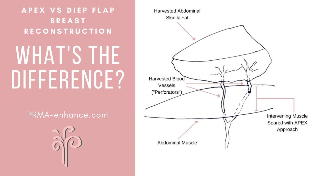 APEX vs DIEP Flap Breast Reconstruction : What's the Difference?
