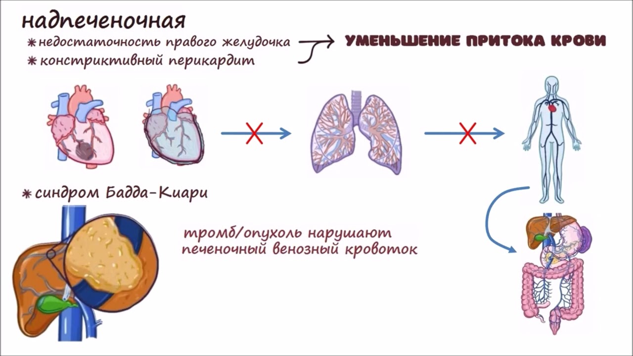 Портальная Гипертензия