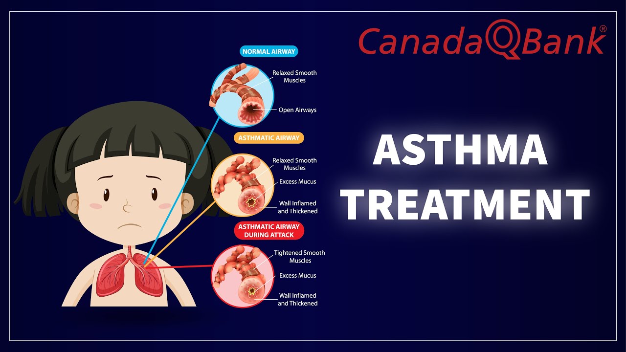 Asthma Treatment: Stepwise Approach, Inhalers, Triggers & Management | High-Yield for USMLE & MCCQE