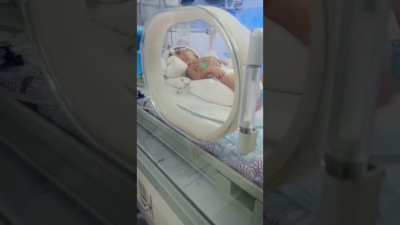 Pray for This Brave Baby 💔 | TEF Surgery Fighter on Ventilator#doctor #ytshorts