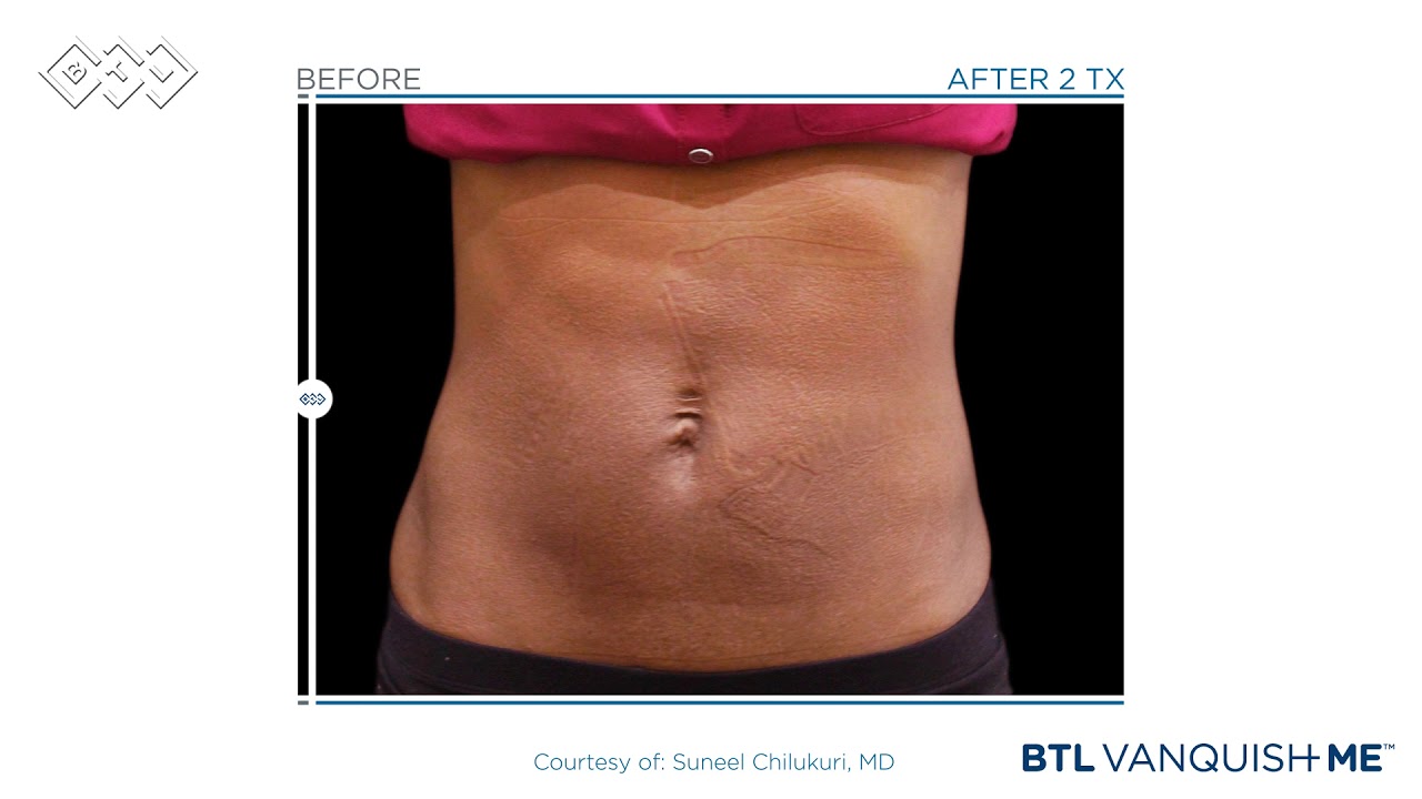 BTL Vanquish ME - Patient Results