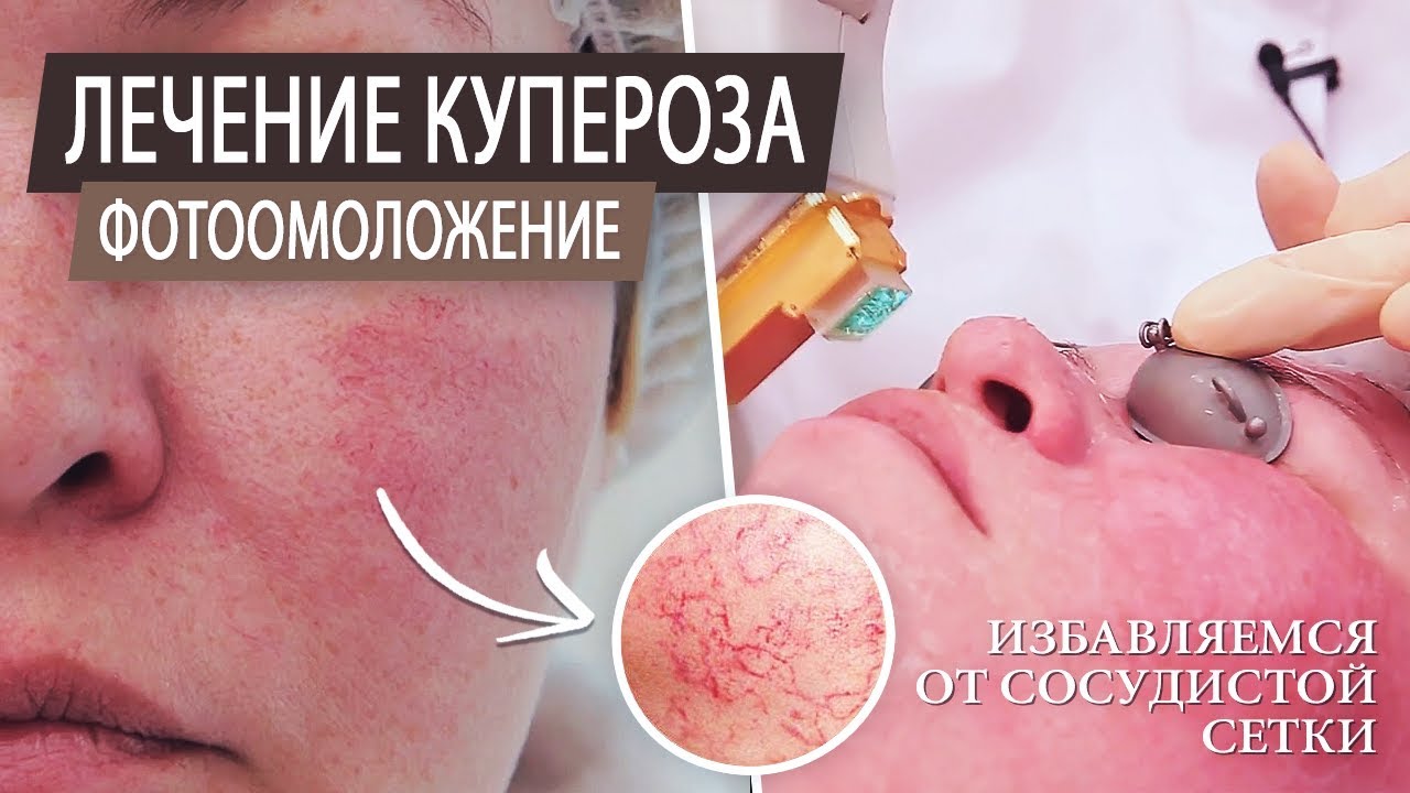 Фотоомоложение \ Лечение купероза на лице \ Чистка лица \ Аппаратная косметология