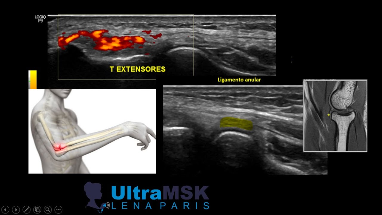 EPICONDILITIS LATERAL/TENDINOPATIA EXTENSORA CODO