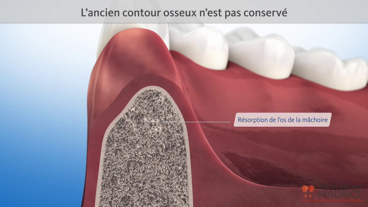Traitement de préservation osseuse après une extraction dentaire - Centre Implant Maurice