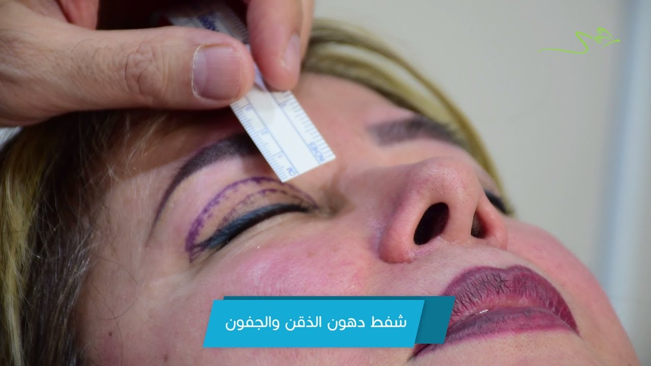 نحت الذقن والتخلص من ترهلات الجفون والنتائج مفاجأة - دكتور جمال جمعة