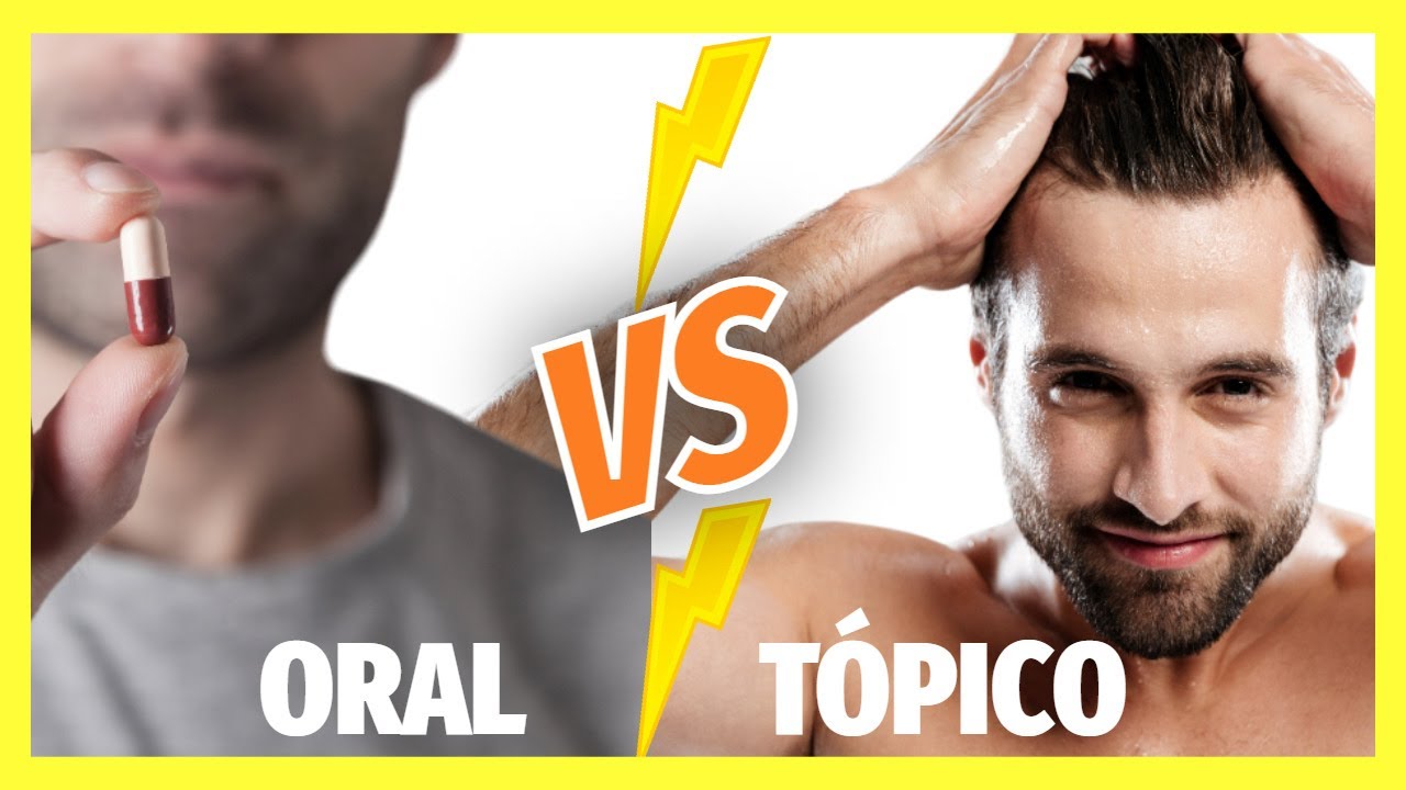 Tratamiento Alopecia: Minoxidil ORAL vs T&Oacute;PICO