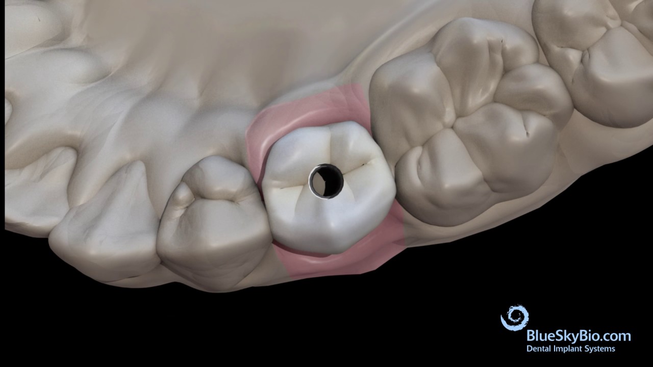 Screw Retained Crown Laboratory Bonding