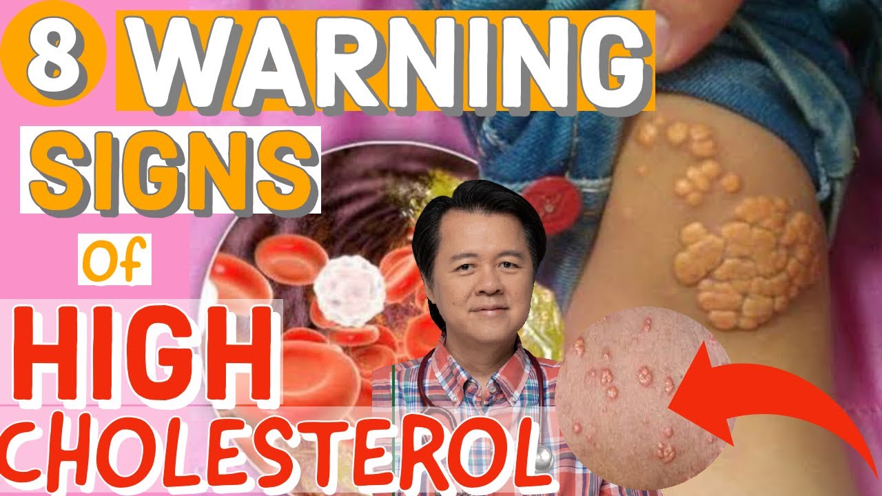 8 Warning Signs of High Cholesterol - By Doc Willie Ong 