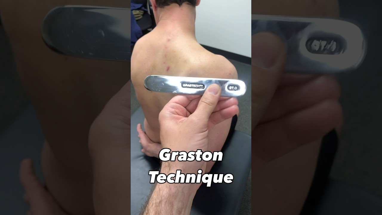 Graston Technique for an Upper Trap Strain