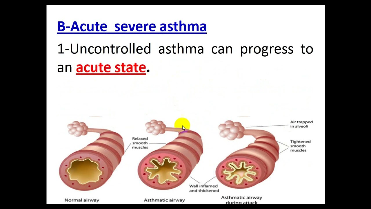 Asthma 2024 By Dr  Dheyaa Jabbar