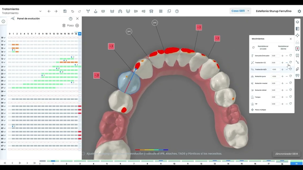 Design a class II case in minutes