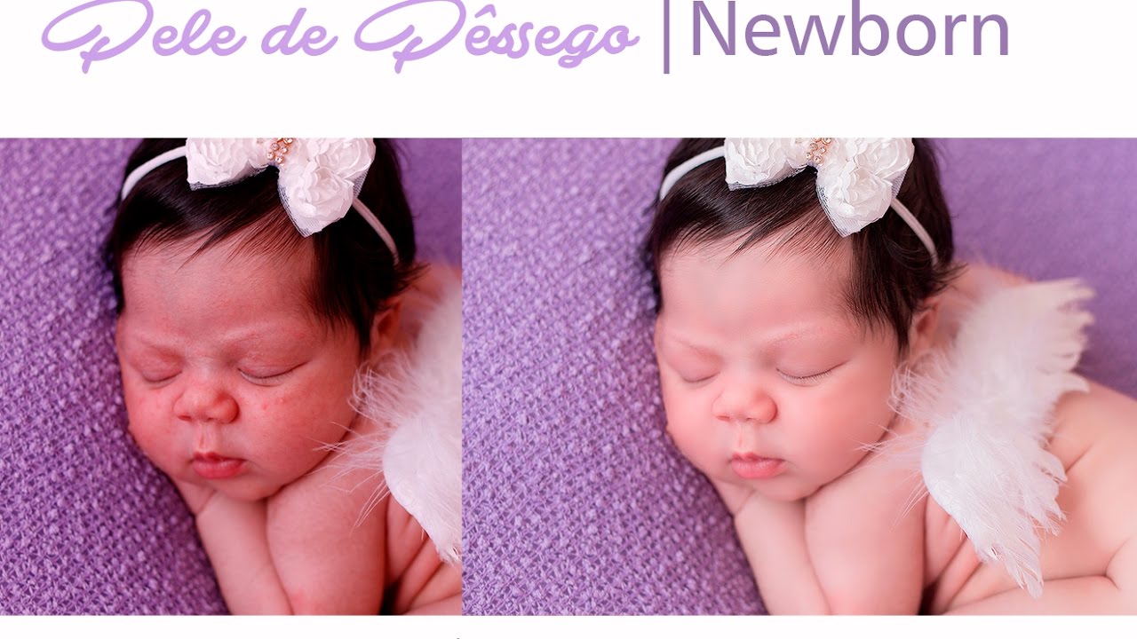 Tratamento Pele de Pêssego em Newborn no Ps