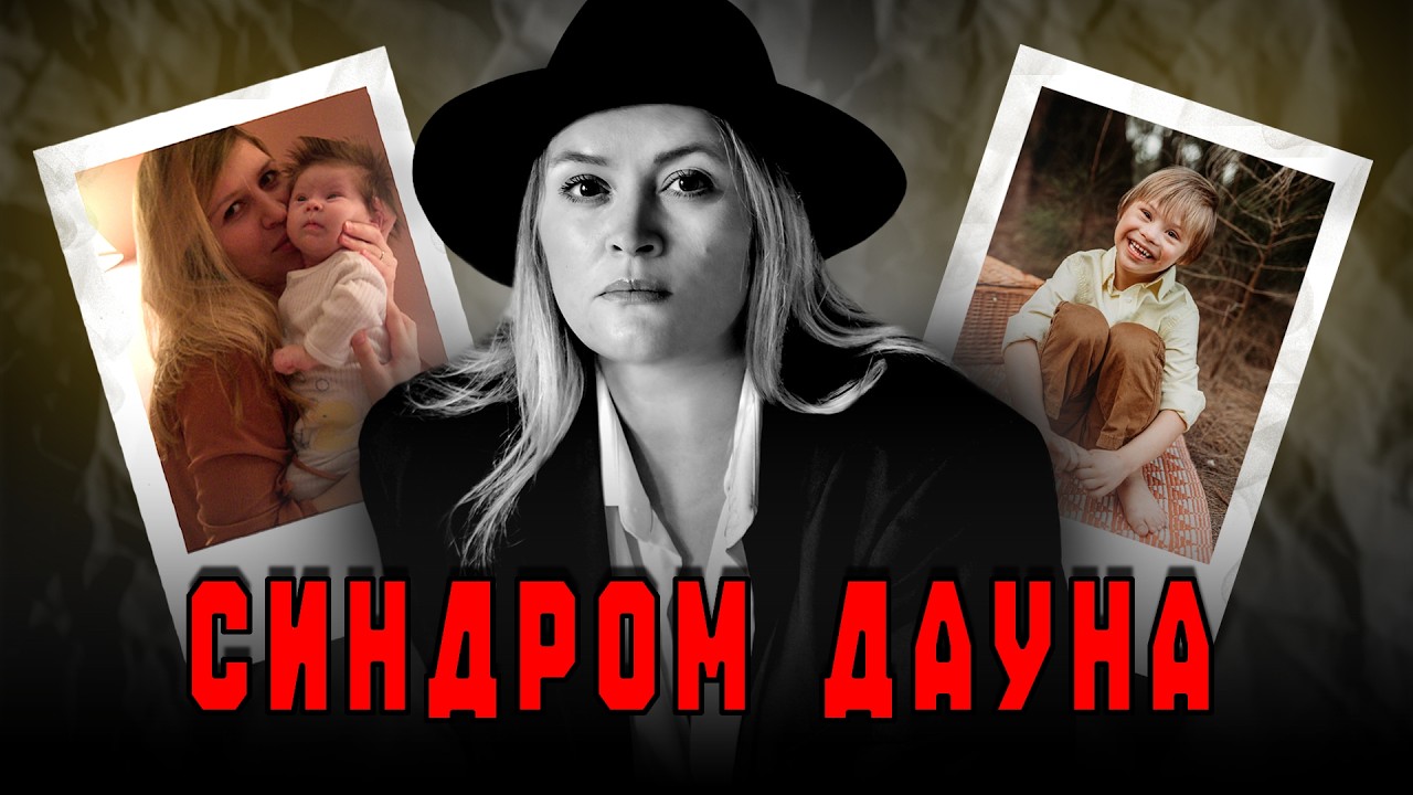 Синдром Дауна: 