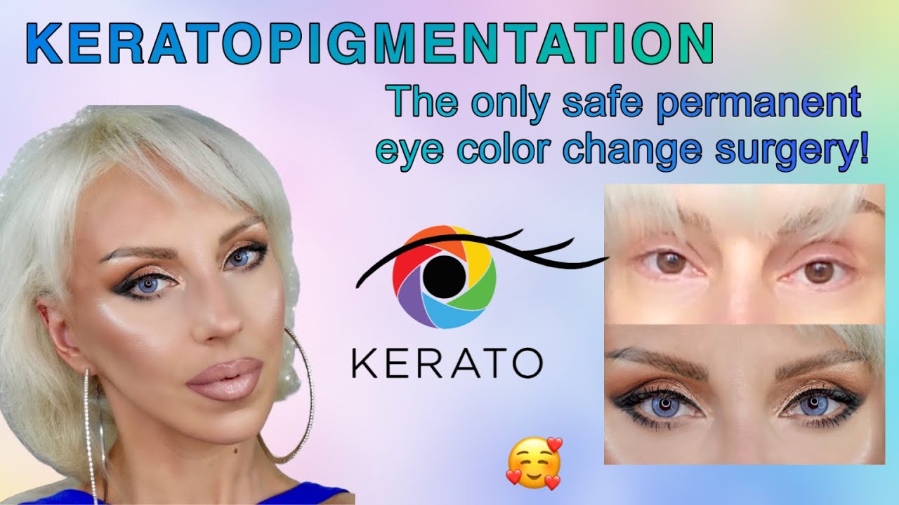 I CHANGED MY EYE COLOR AT KERATONYC, KERATOPIGMENTATION, FRENCH BLUE, MEDIUM INTENSITY