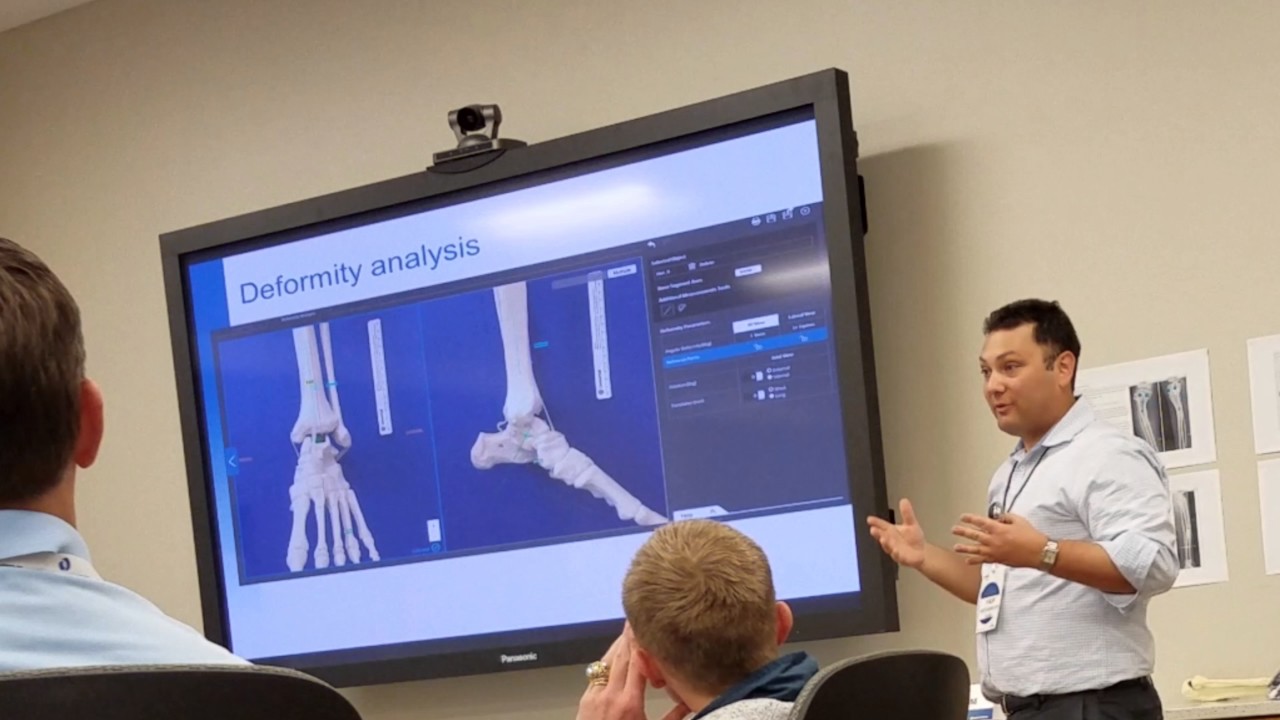 Ankle equinus gradual deformity correction via hexapod external fixator