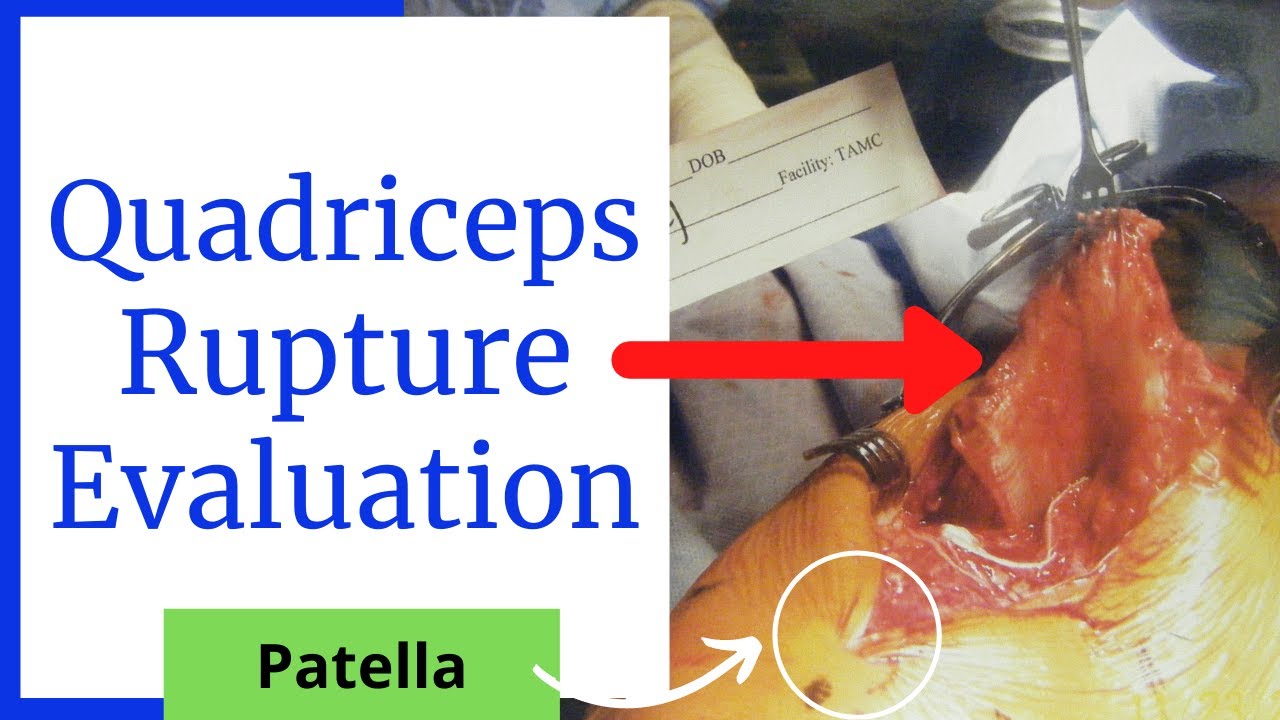 Quadriceps Rupture Evaluation-Acute Tear!