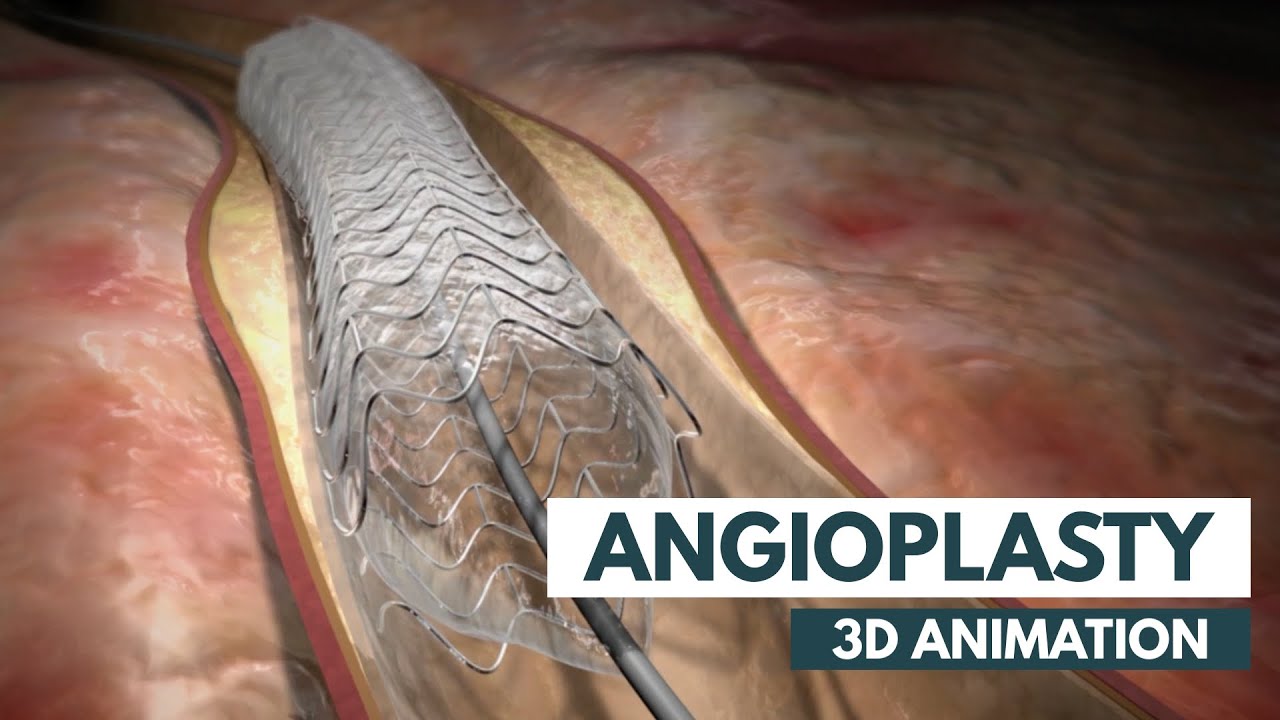 Angioplasty |&nbsp;3D Animation + Real Footage