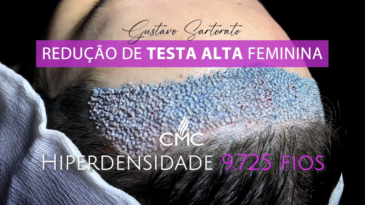 Redu&ccedil;&atilde;o de TESTA ALTA feminina
