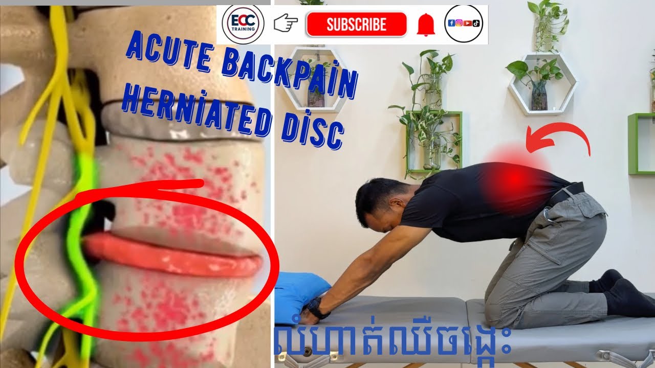 ✅ឈឺចង្កេះឬលានឌីសមើលវីឌីអូនេះ #P01 ឈឺចង្កេះនិង លំហាត់លានឌីសចង្កេះ  Acute backpain herniated disc