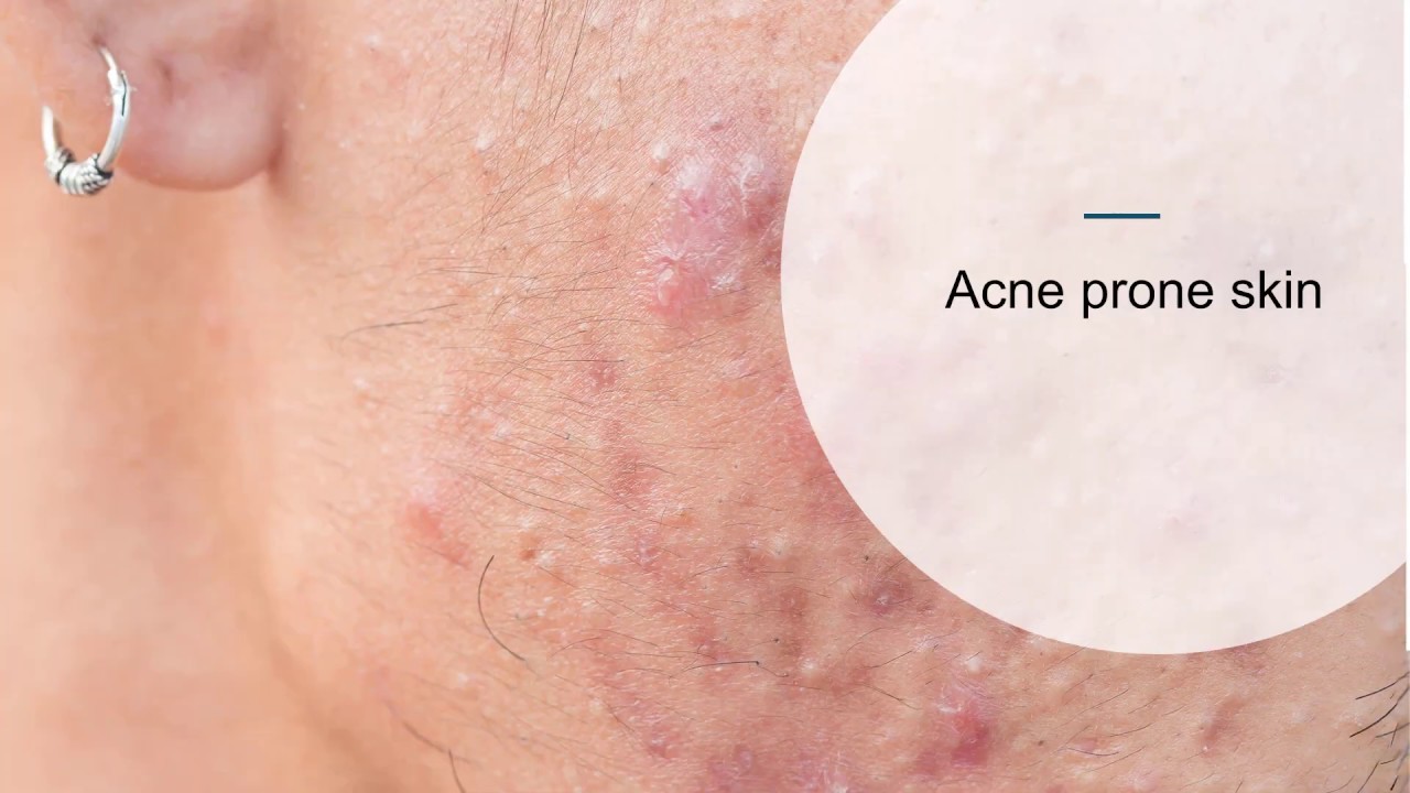 Skin Skills webinar Chemical Peels