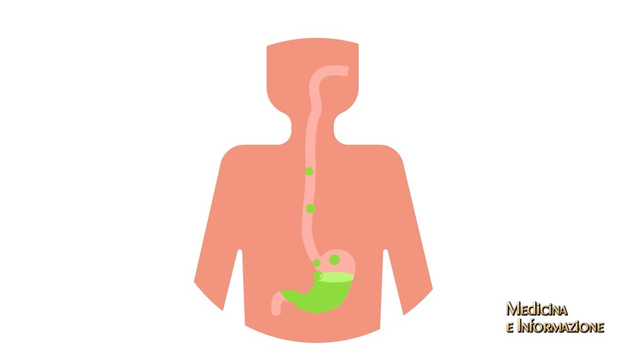 Reflusso Gastroesofageo -  Nuove tecniche endoscopiche di trattamento