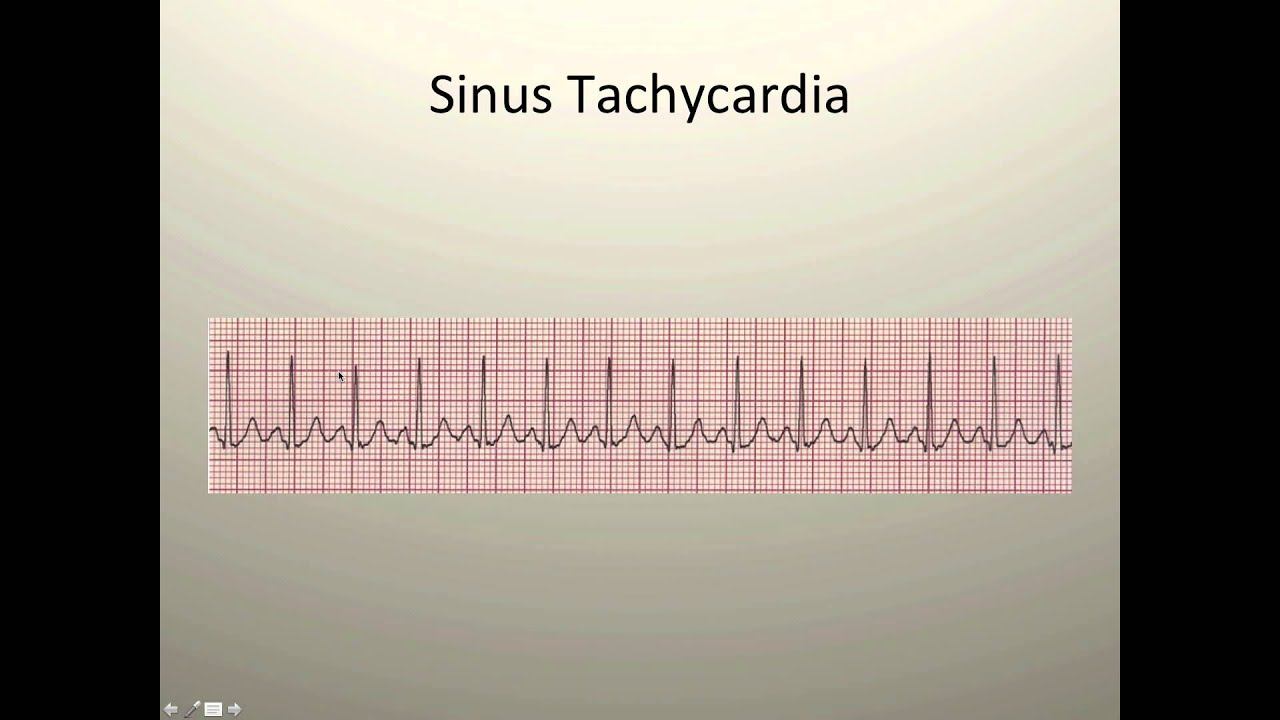 Sinus Tachycardiac, Bradycardia, Dysrhythmia