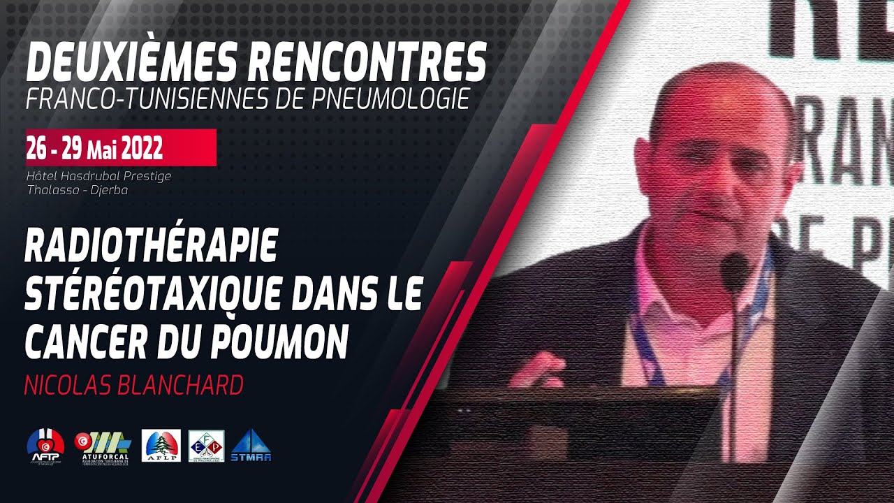 Radiothérapie stéréotaxique dans le cancer du poumon