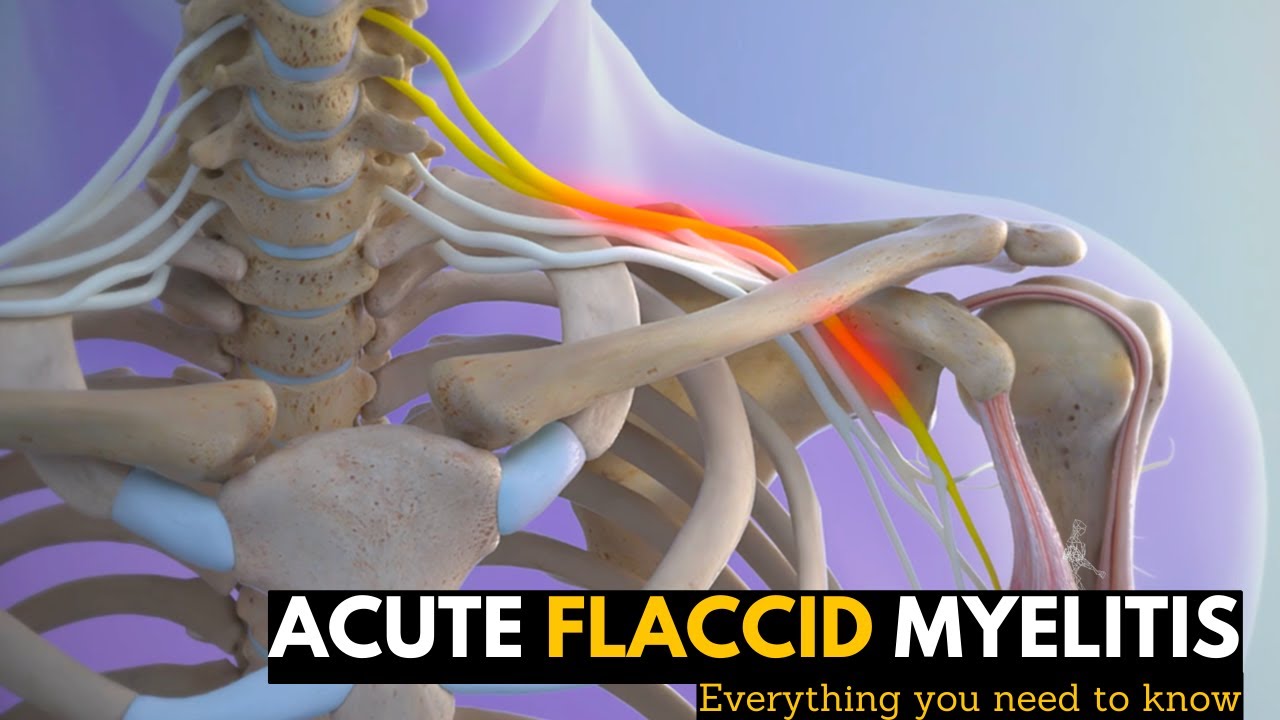 Acute Flaccid Myelitis: Everything You Need To Know