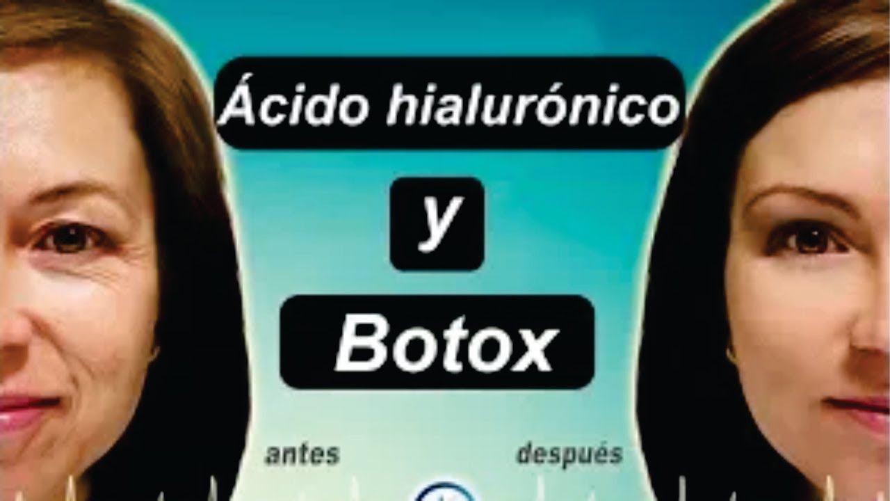 BOTOX vs ÁCIDO HIALURÓNICO 💚💙💜 ADIOS ARRUGAS 💋 DR. ALBERTO CALVO - MEDICINA EXTRAORDINARIA