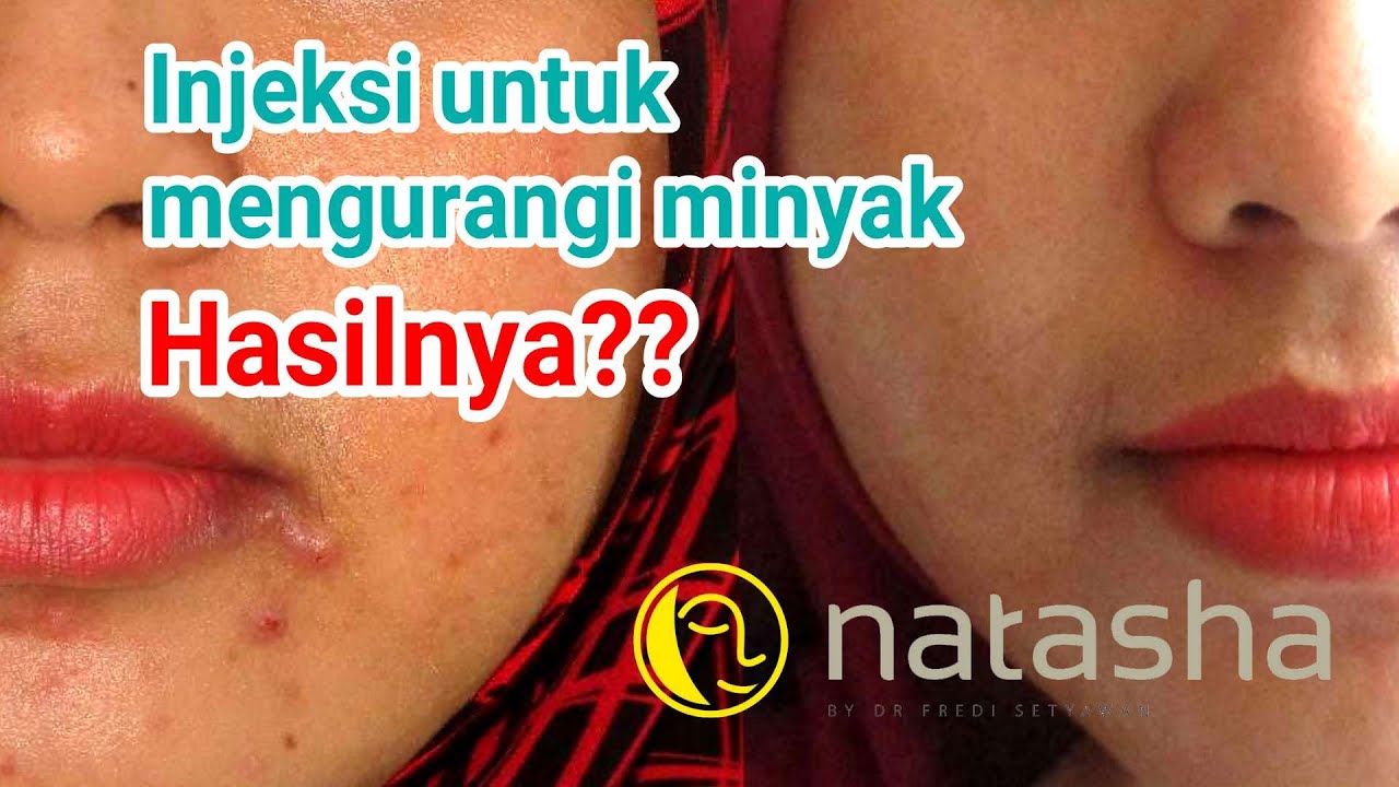 Before-After Pasca Microbotox | Injeksi Muka Antikeriput & Antiminyak berlebih | Natasha Sidoarjo