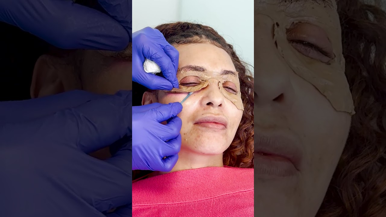 Resultados surpreendentes do Line Skin - Peeling de Fenol