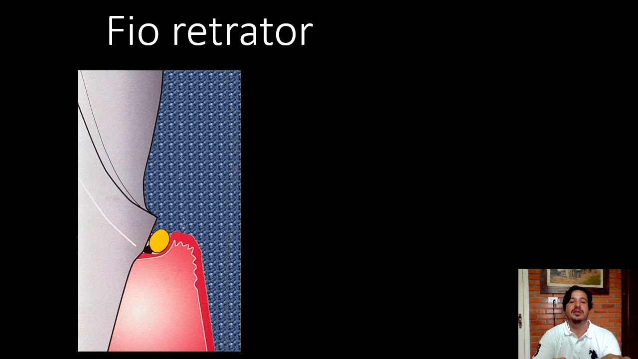 Moldagens em Pr&oacute;tese Fixa 04
