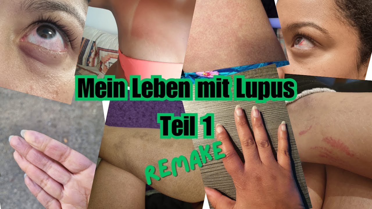 Mein Leben mit Lupus Teil 1 - Remake