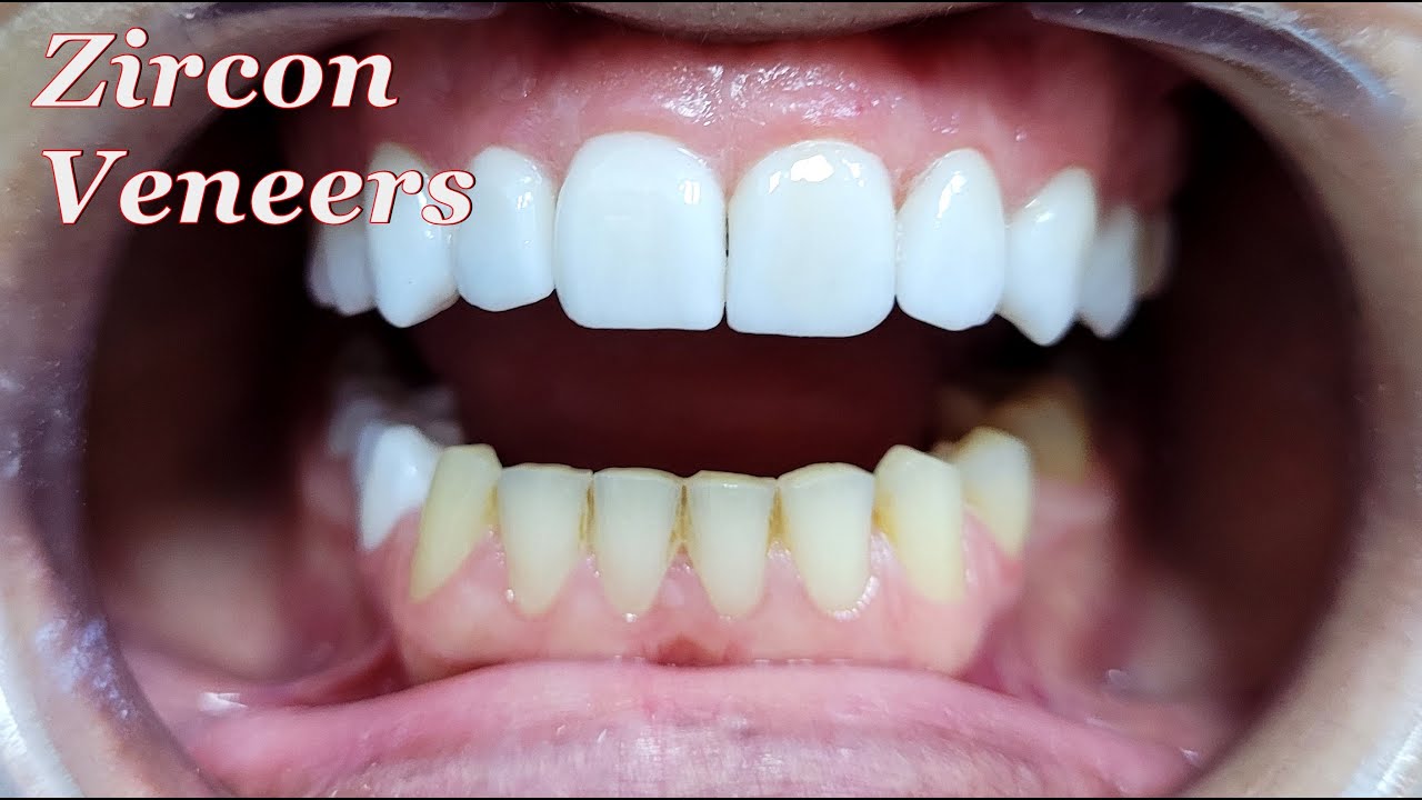 Zircon Veneers multilayer ( Dubai )