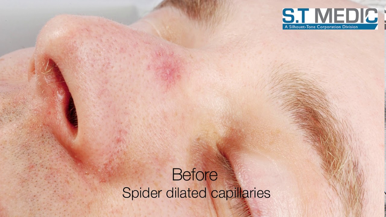 Thermocoagulation system - Before / after