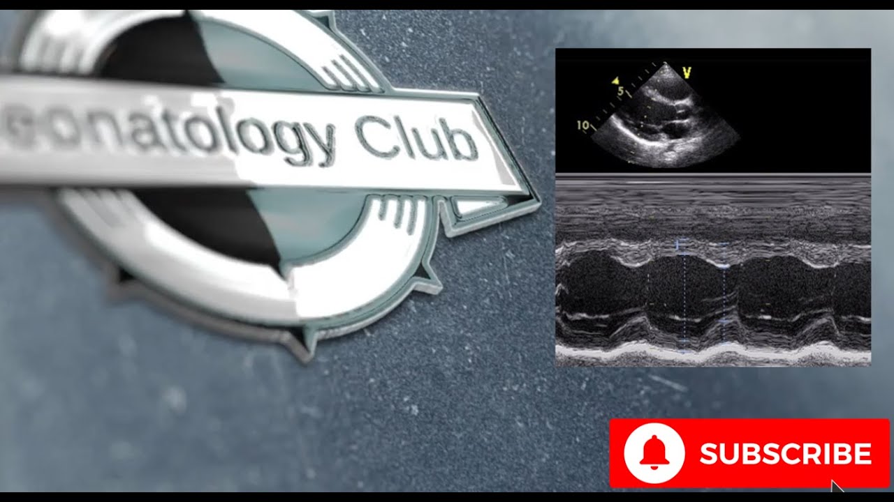 Echocardiographic assessment of afterload #TnEcho