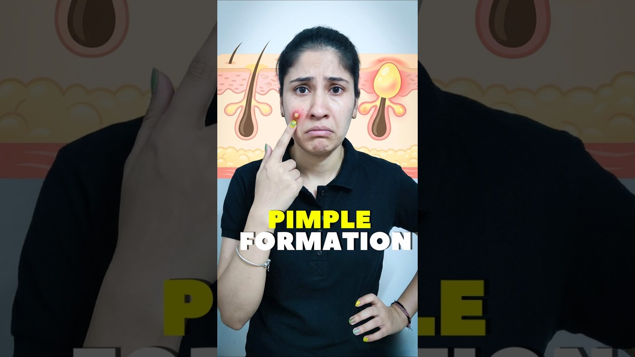 How Pimples Form?