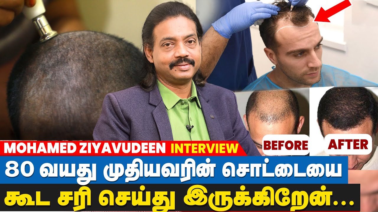 100 நாட்களில் சொட்டை  சரி பண்ணிடுவேன் - Mohamed Ziyavudeen | Hair Regrowth for Men