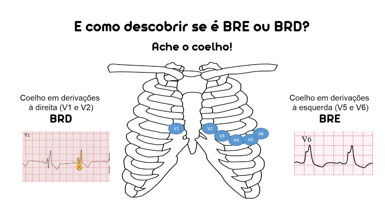 Como diferenciar o bloqueio de ramo direito do esquerdo?