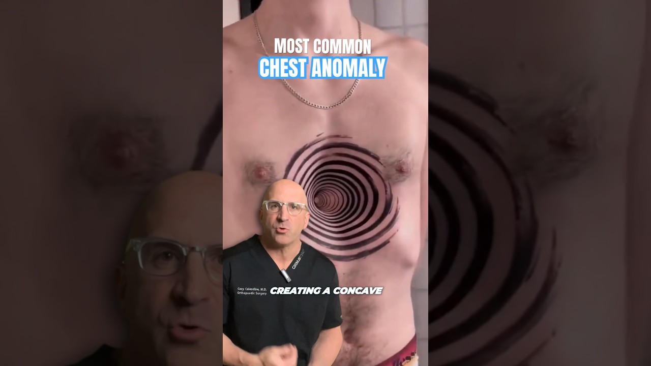 Most Common Pectus Chest Anomaly #shorts