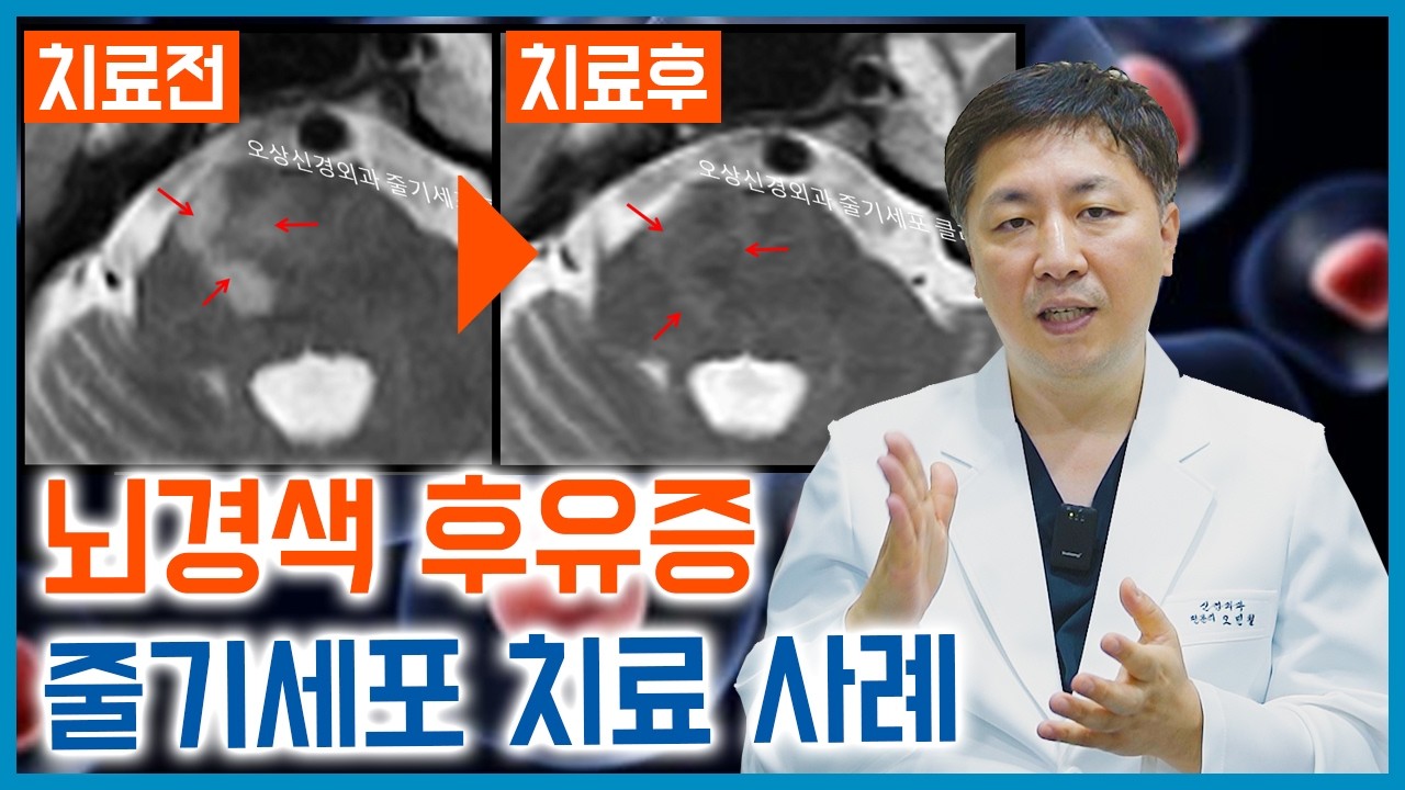 [Eng/CN Sub] 뇌경색 후유증  줄기세포 치료 사례