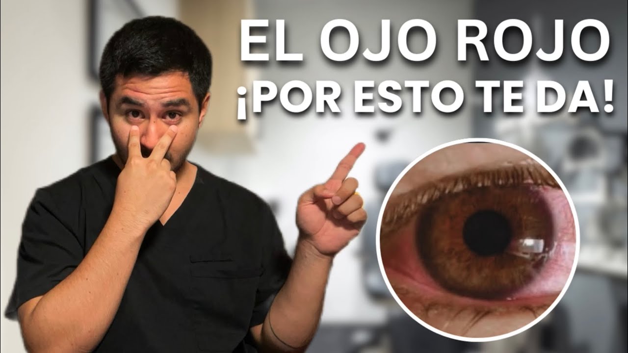 ALERTA! Por Esta Peligrosa Razón Tendrás Ojo Rojo (Y COMO EVITARLO)