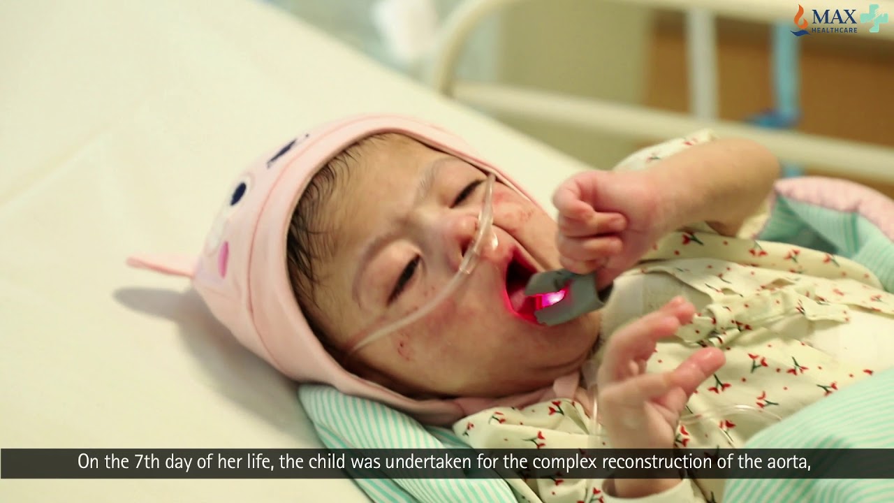 Treatment of Shone's Complex Syndrome with Heart Stent Surgery | Max Hospital