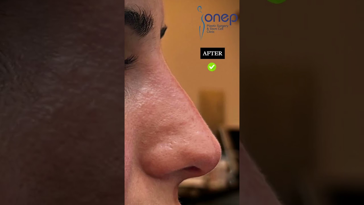 Prof. Dr. Onur Erol Introduces a Revolutionary Technique: The 'Turkish Delight' Nose Surgery...