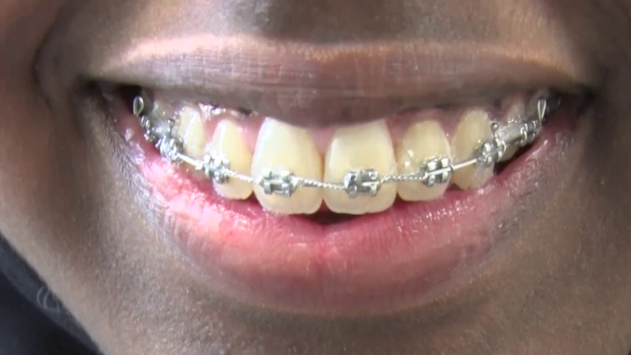 Støtte til tannregulering