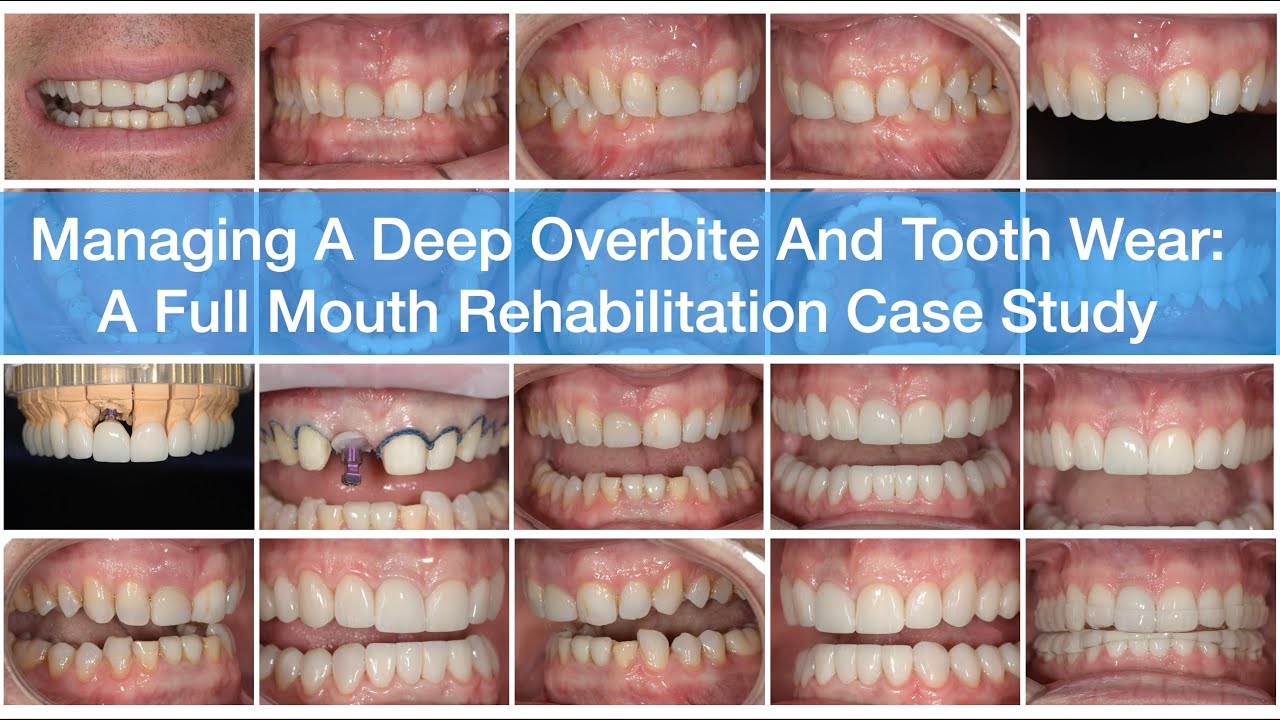 Managing a Deep Overbite and Tooth Wear: A Full Mouth Rehabilitation Case Study