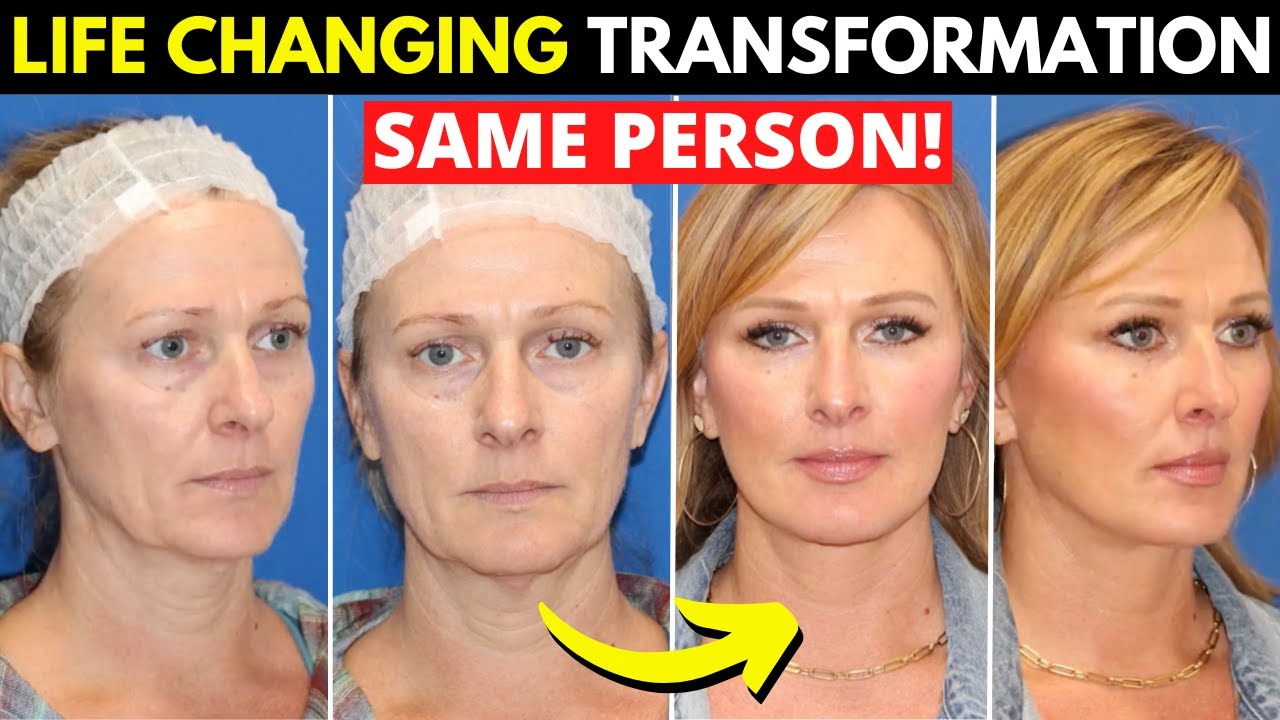 Incredible facelift transformation at 49 years old!