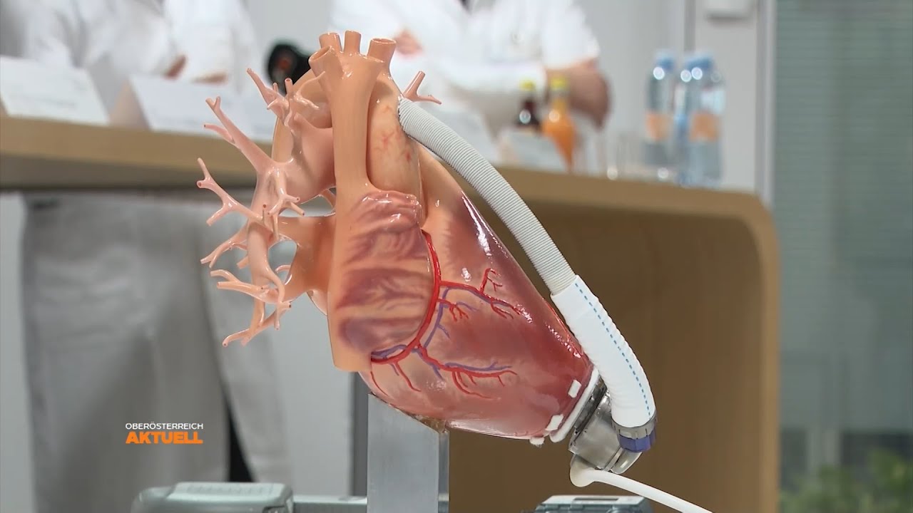 Fünf Jahre Kunstherzimplantation am Kepler Uniklinikum