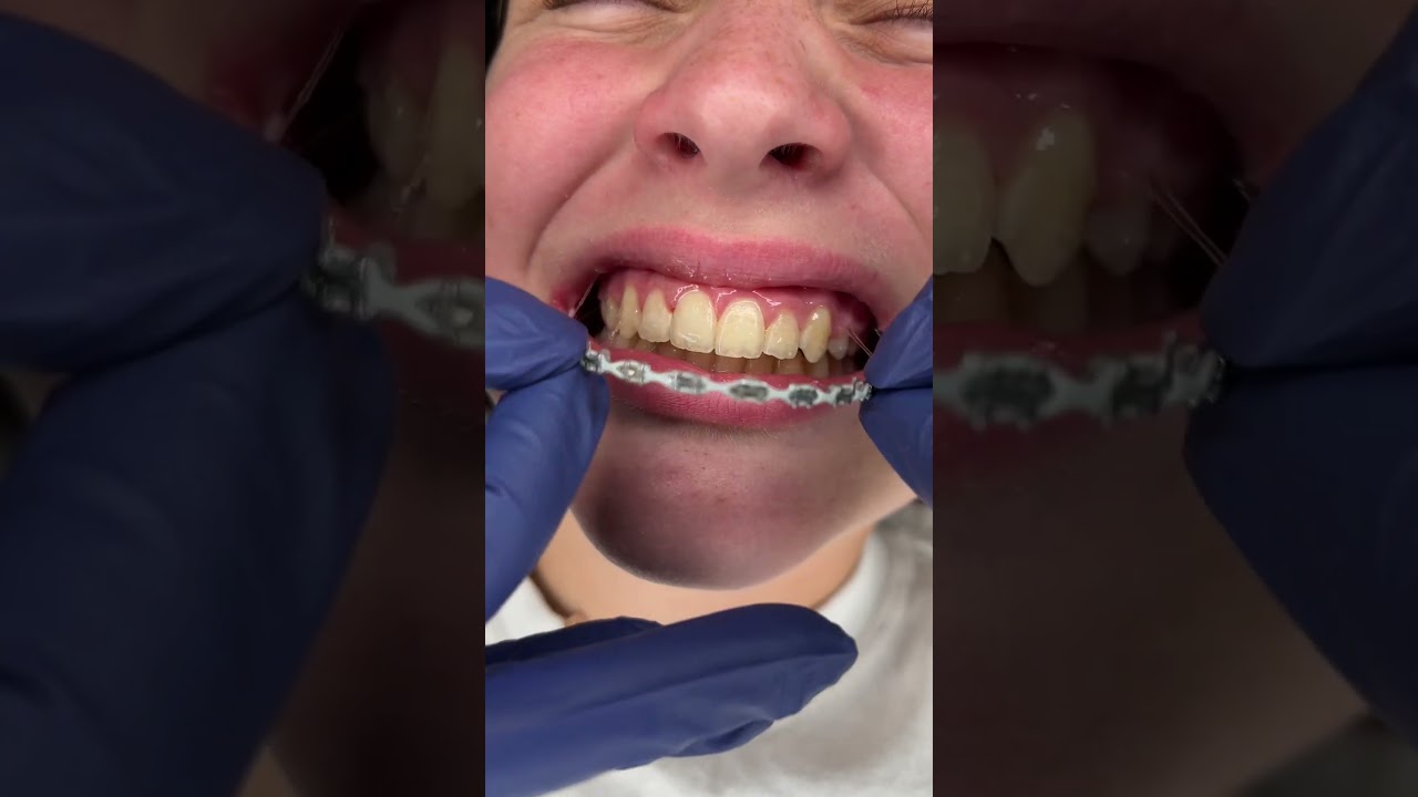 Braces Off !
