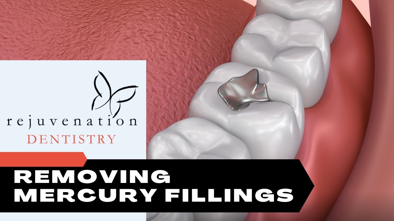 Why You Must Remove Your Toxic Silver Mercury Fillings For Better Health